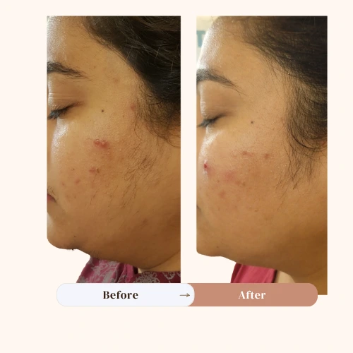 laser hair removal treatment - TDA