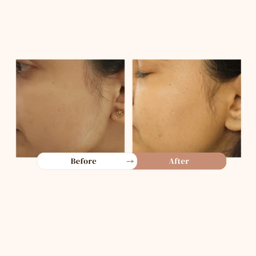laser hair removal treatment