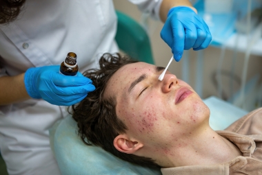 Acne & Scar Treatments in Kharadi, Pune