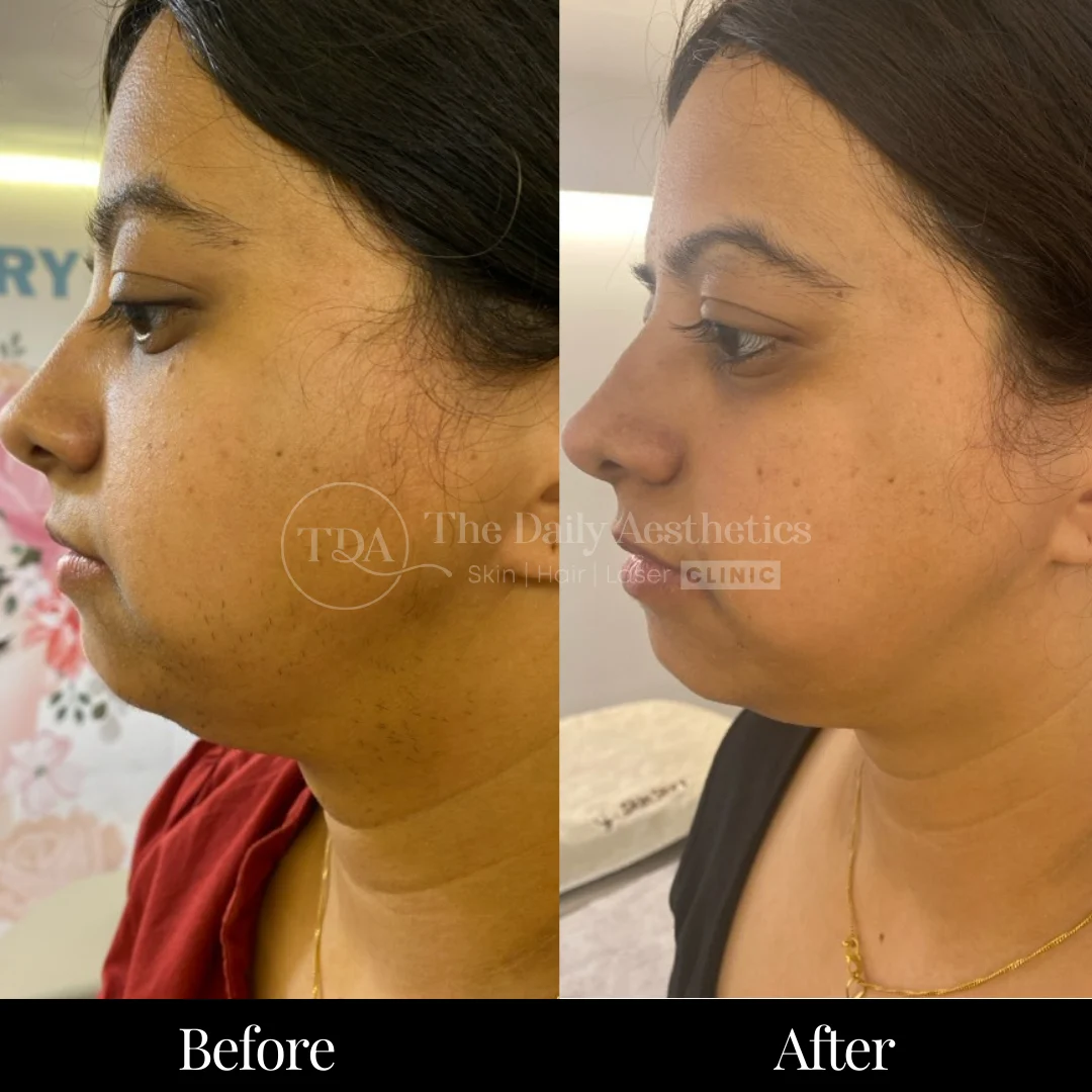 Laser Hair Removal Before & After Results 1