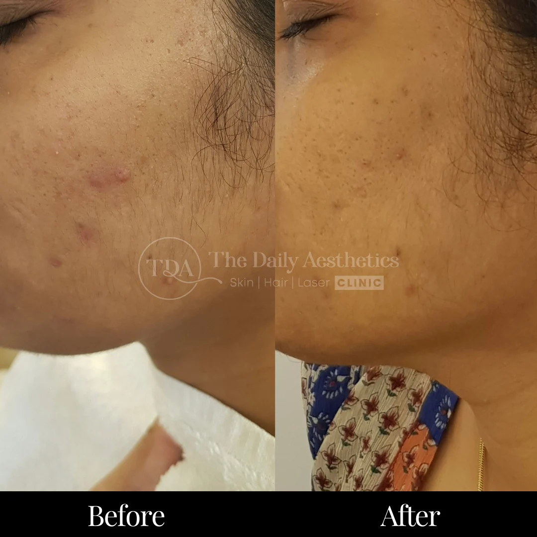 Laser Hair Removal Before & After Results 2
