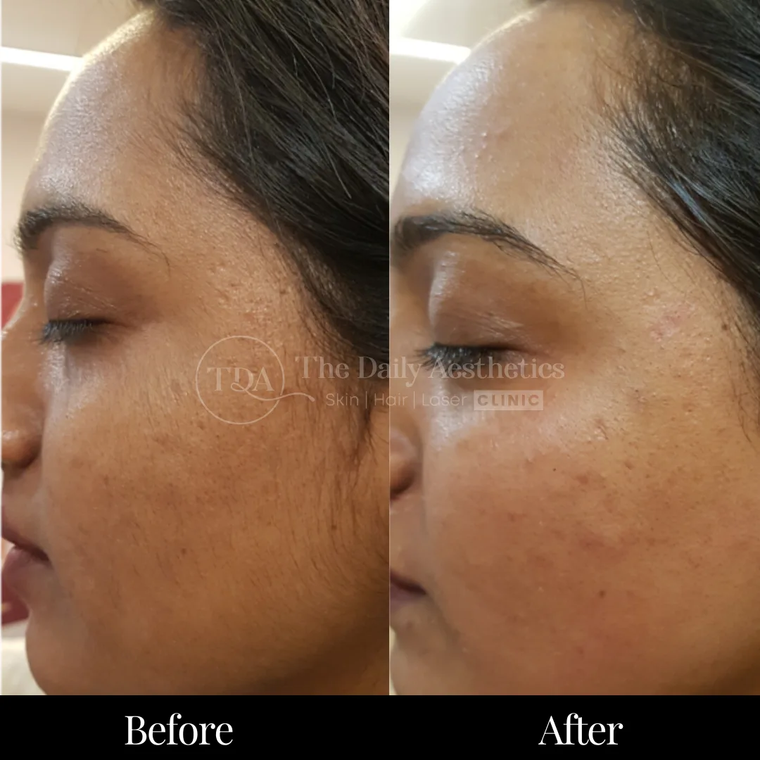 Laser Hair Removal Before & After Results 3