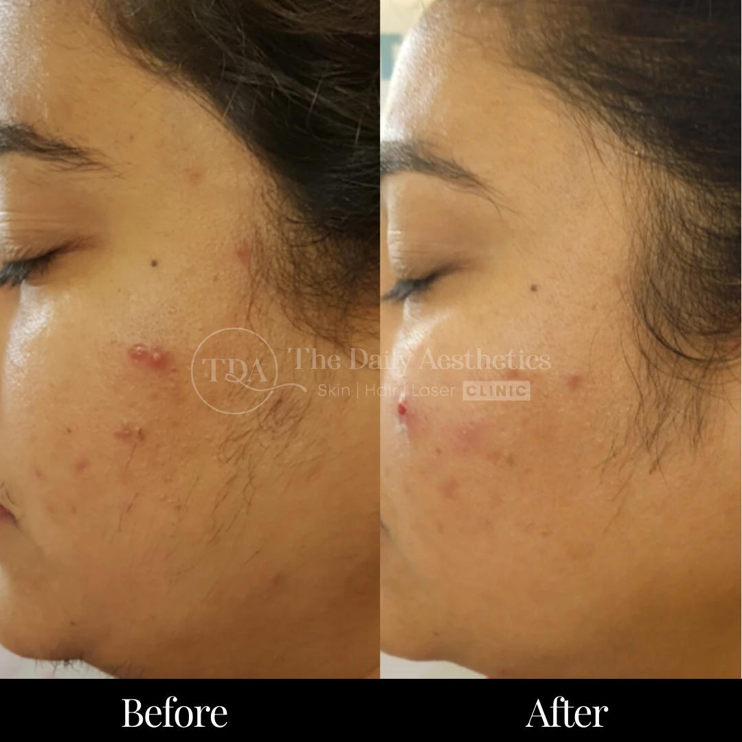 Laser Hair Removal Before & After Results 4