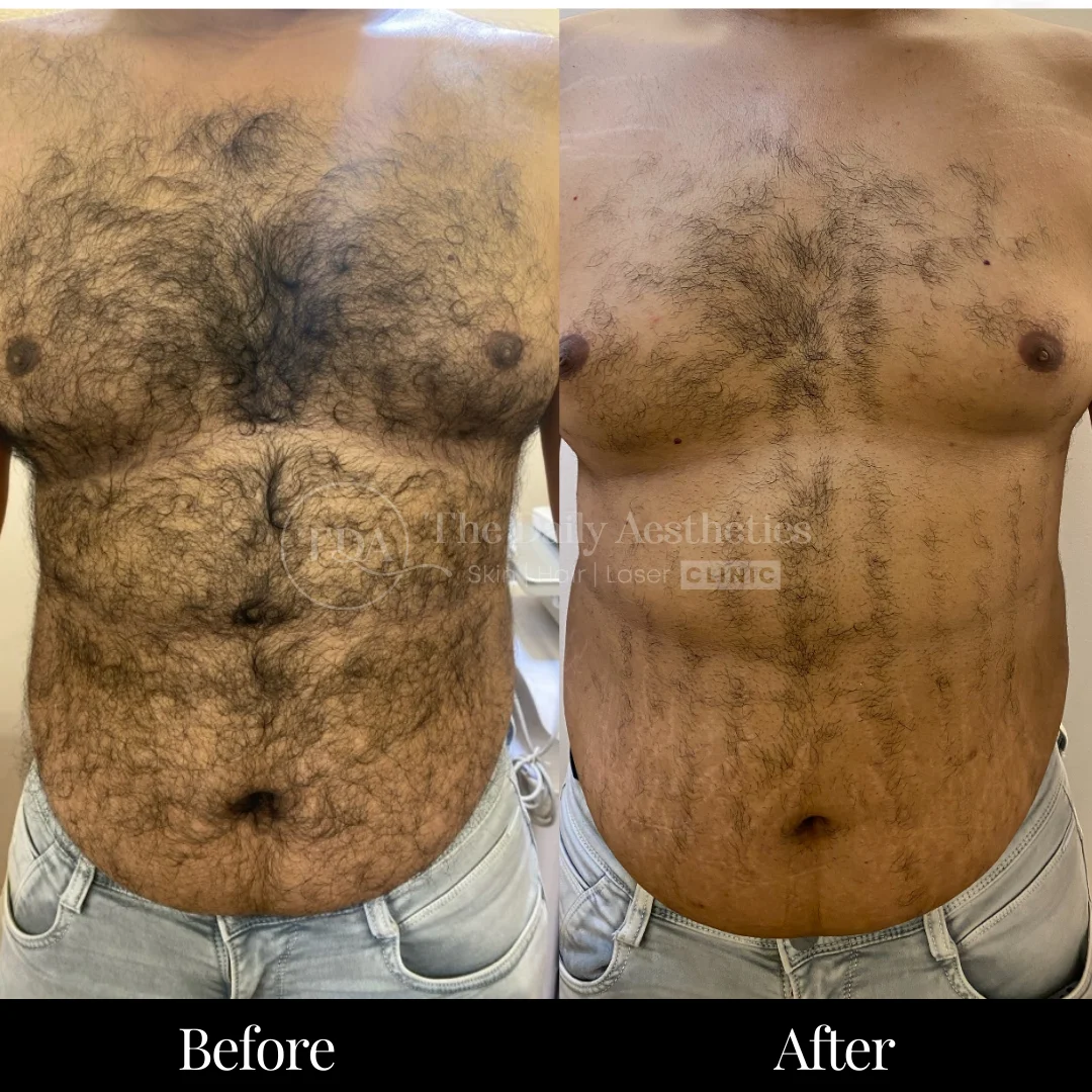 Laser Hair Removal Before & After Results 5