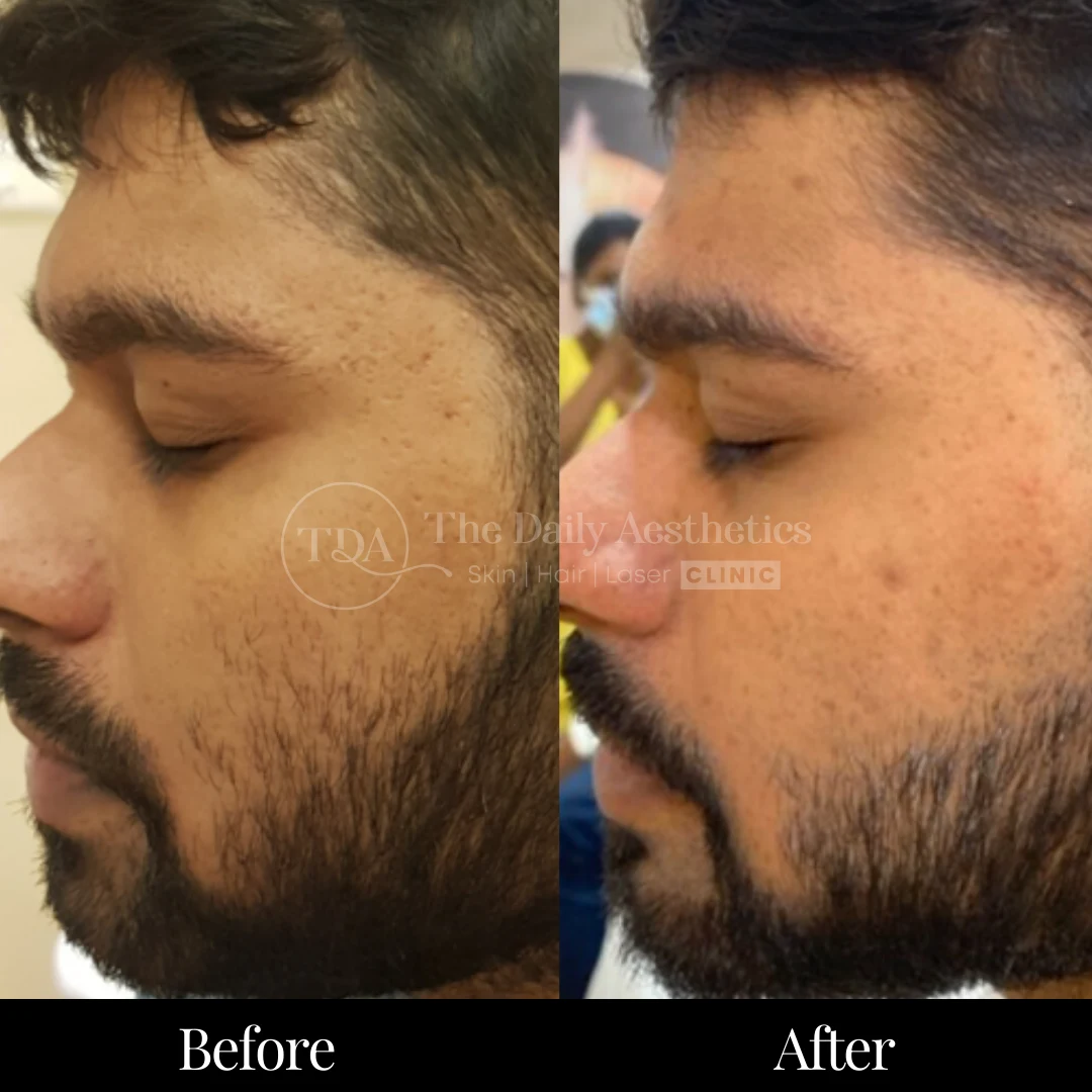 Laser Hair Removal Before & After Results 6
