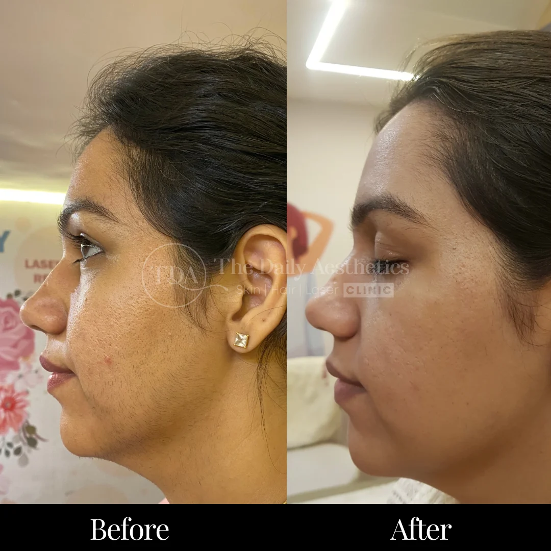 Laser Hair Removal Before & After Results 7