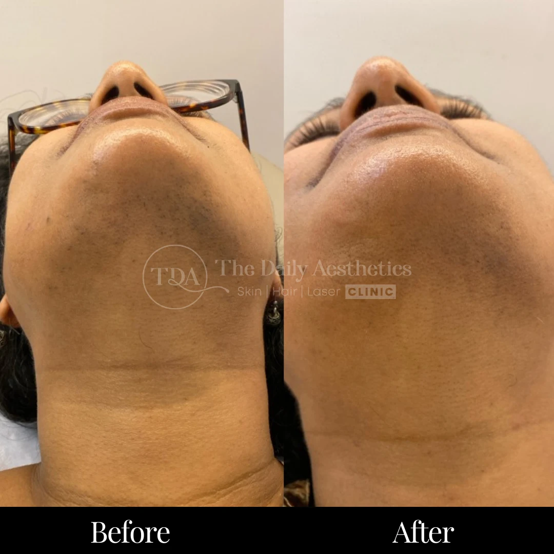 Laser Hair Removal Before & After Results 8