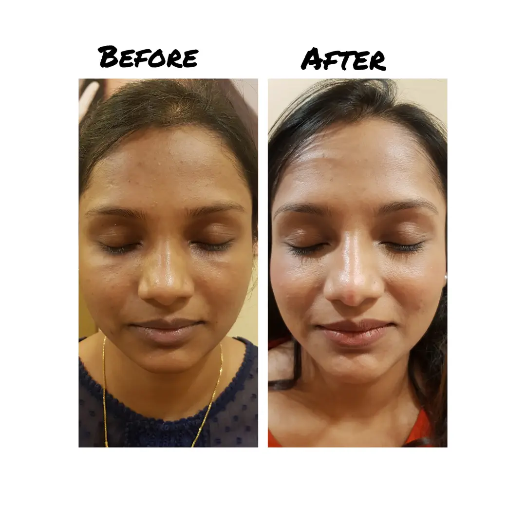 Before and After Results of Glutathione IV Drip Therapy