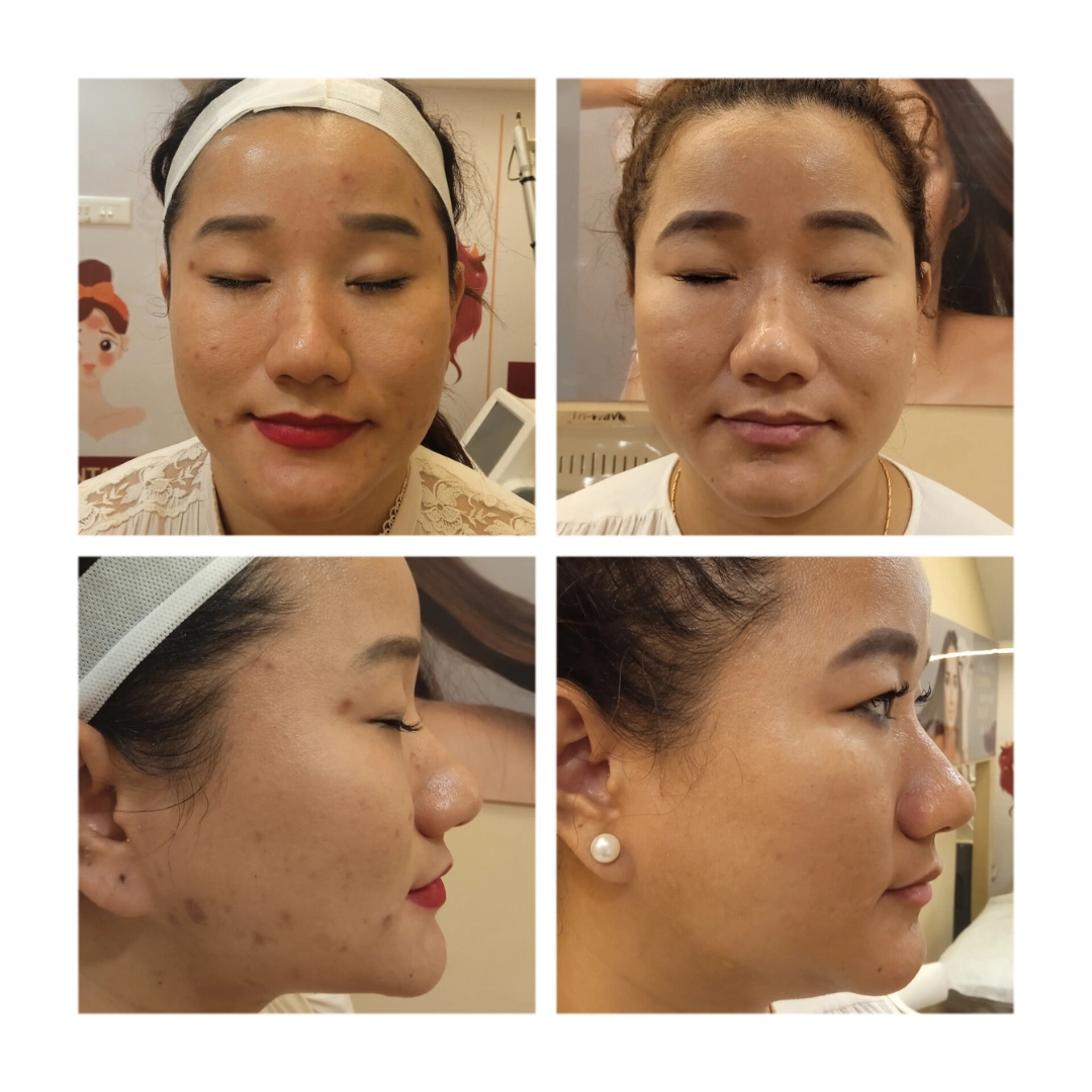 Dermal Fillers Before & After Results 1