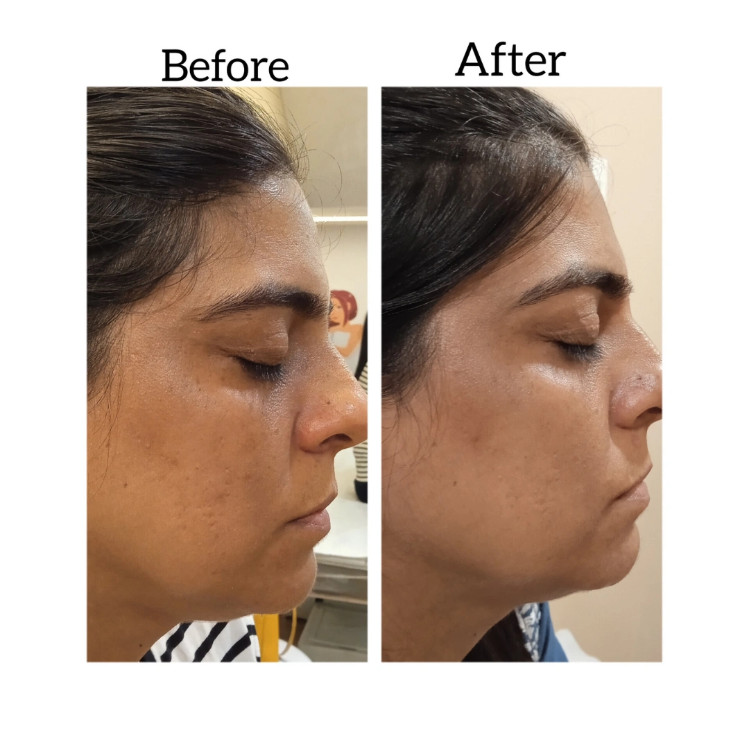 Dermal Fillers Before & After Results 2