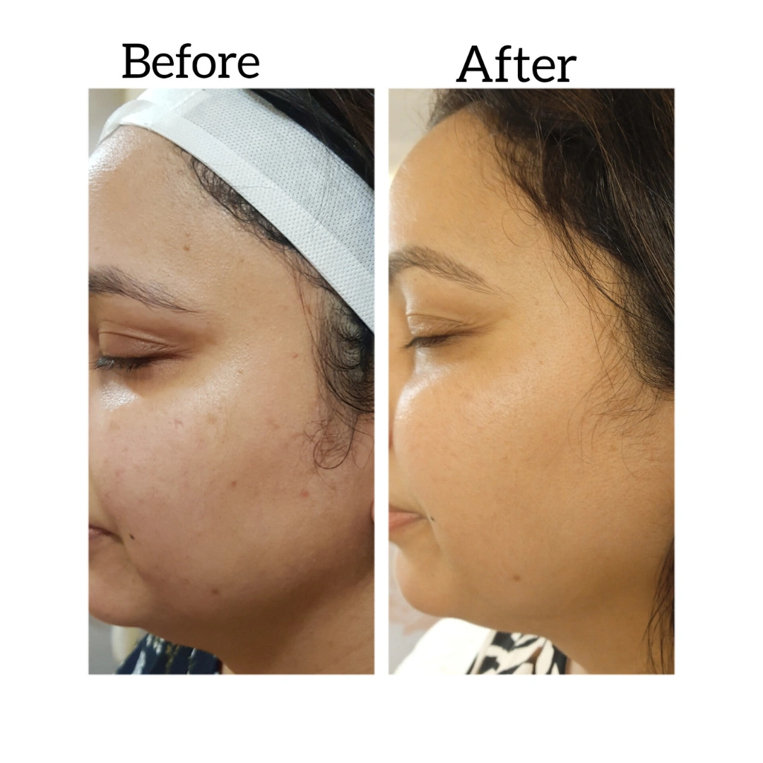 Dermal Fillers Before & After Results 3