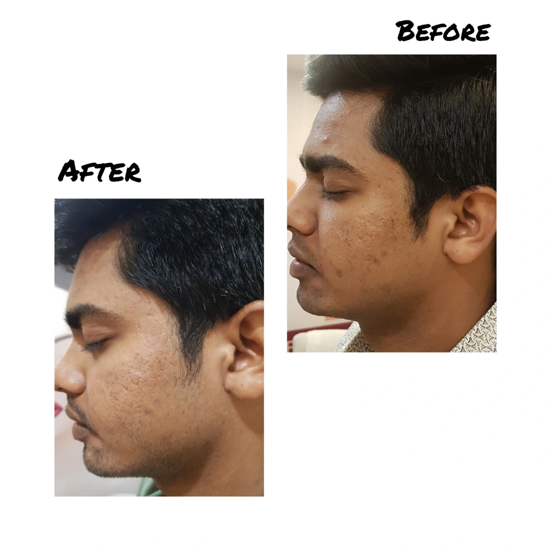 Dermal Fillers Before & After Results 4