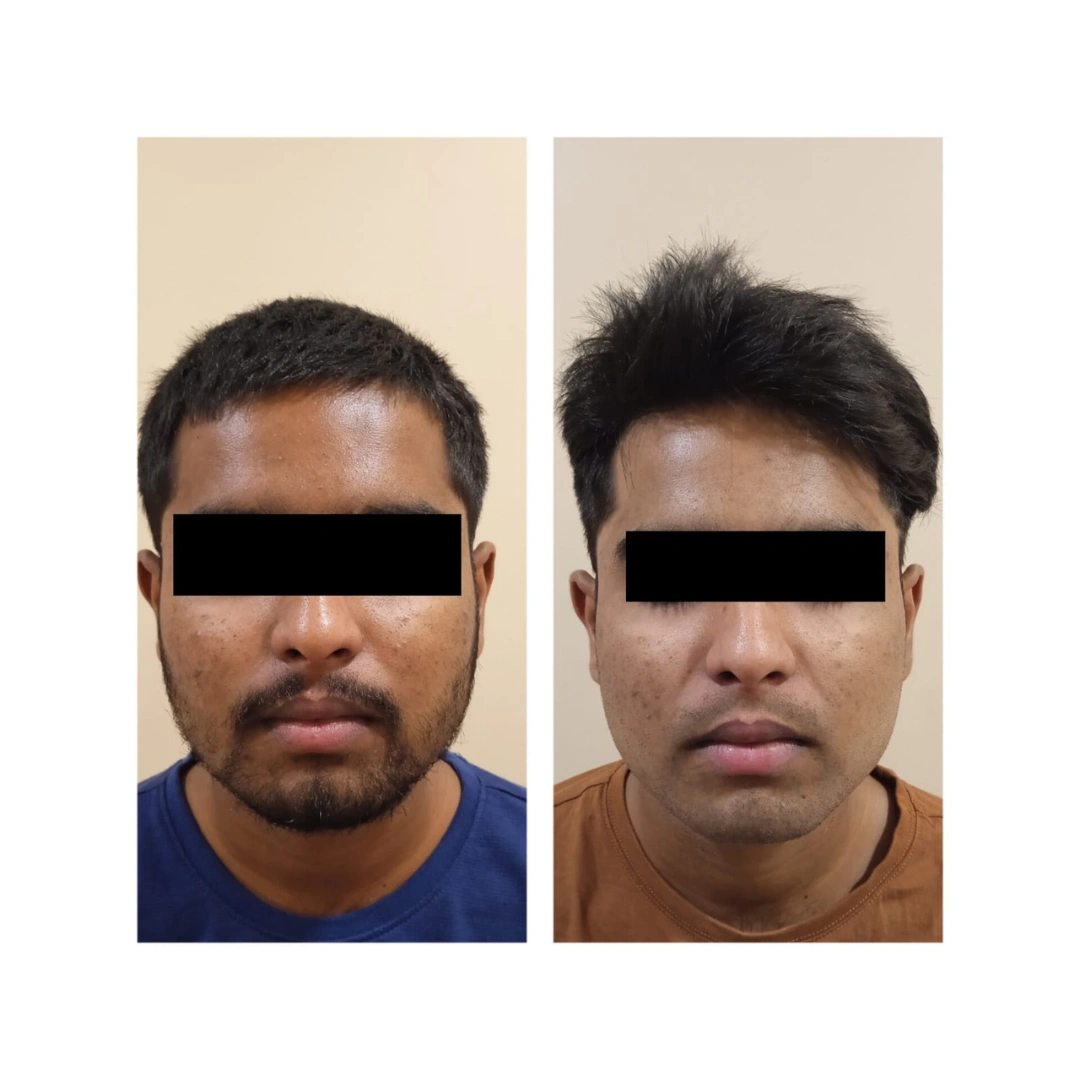 Dermal Fillers Before & After Results 5