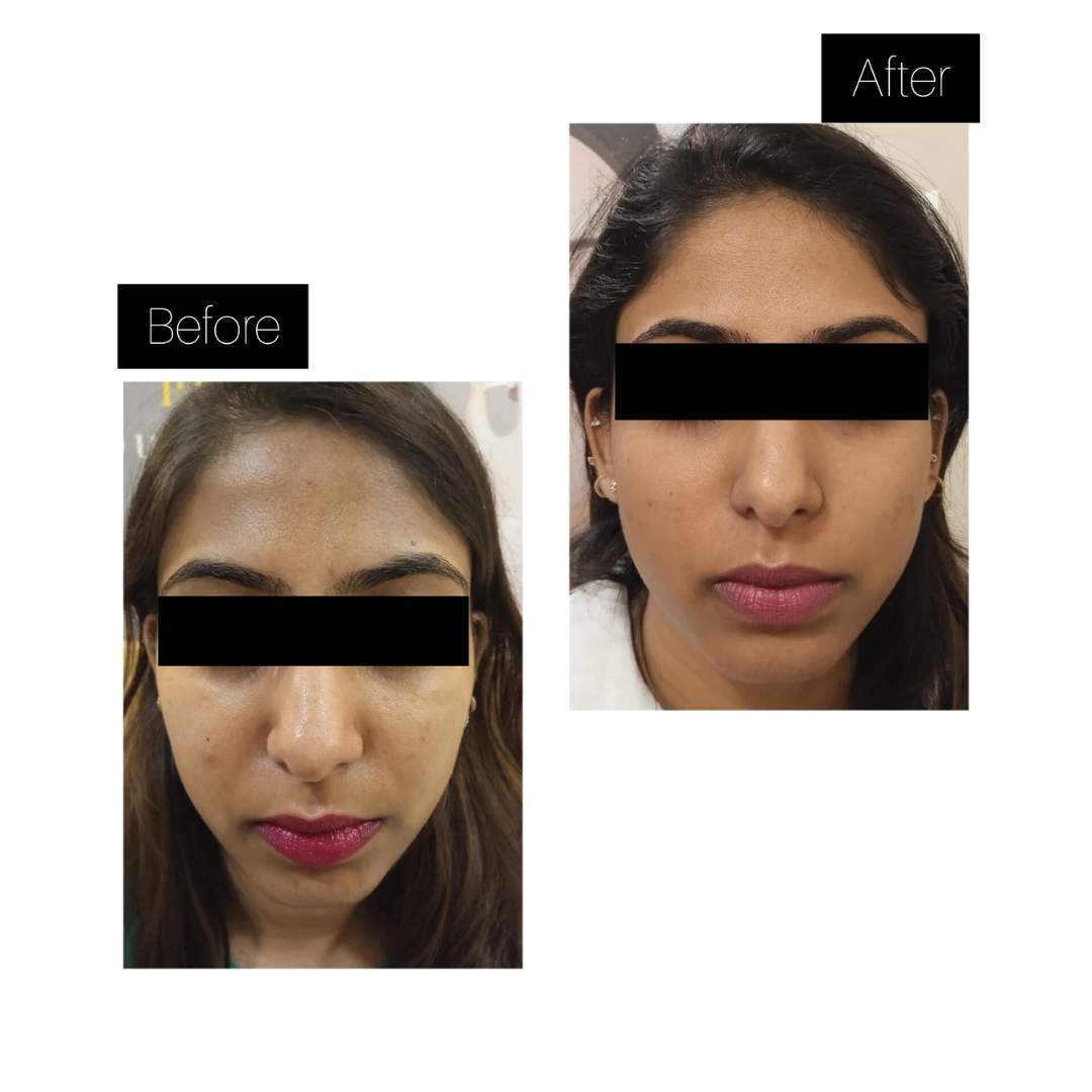 Glutathione IV Drip Therapy Before & After Results 2