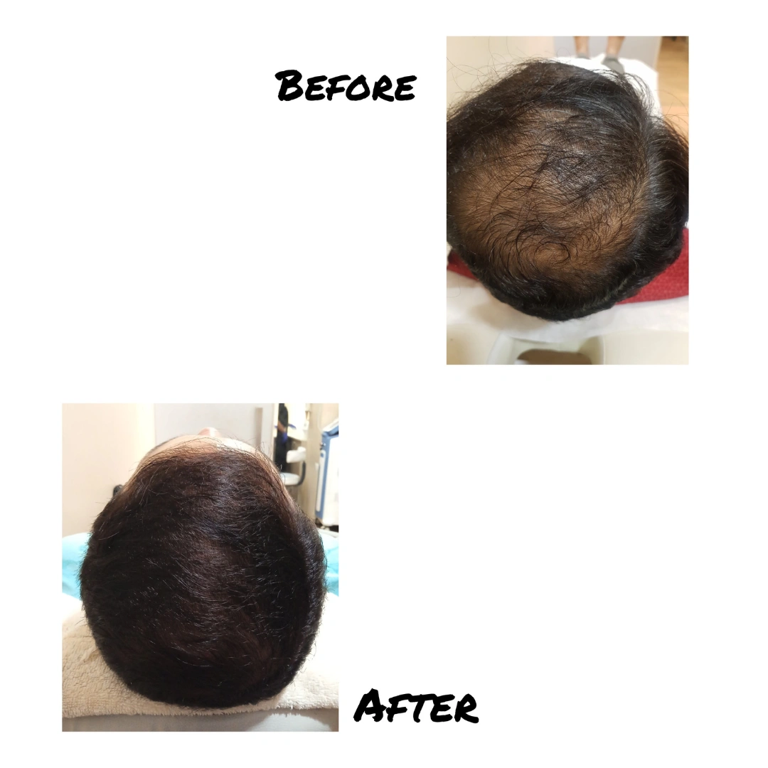 Hair Transplant Before & After Results 1