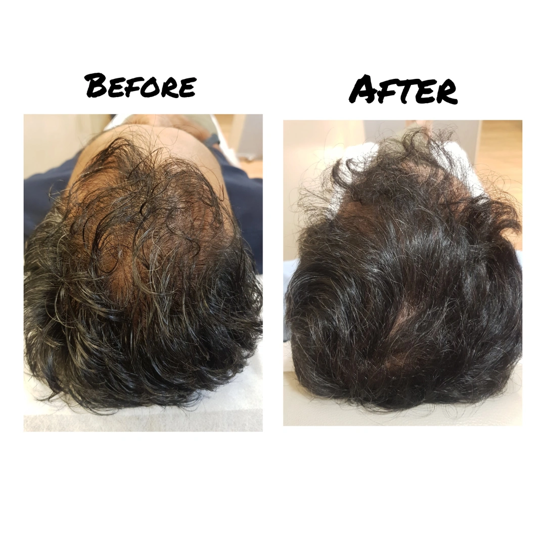 Hair Transplant Before & After Results 2