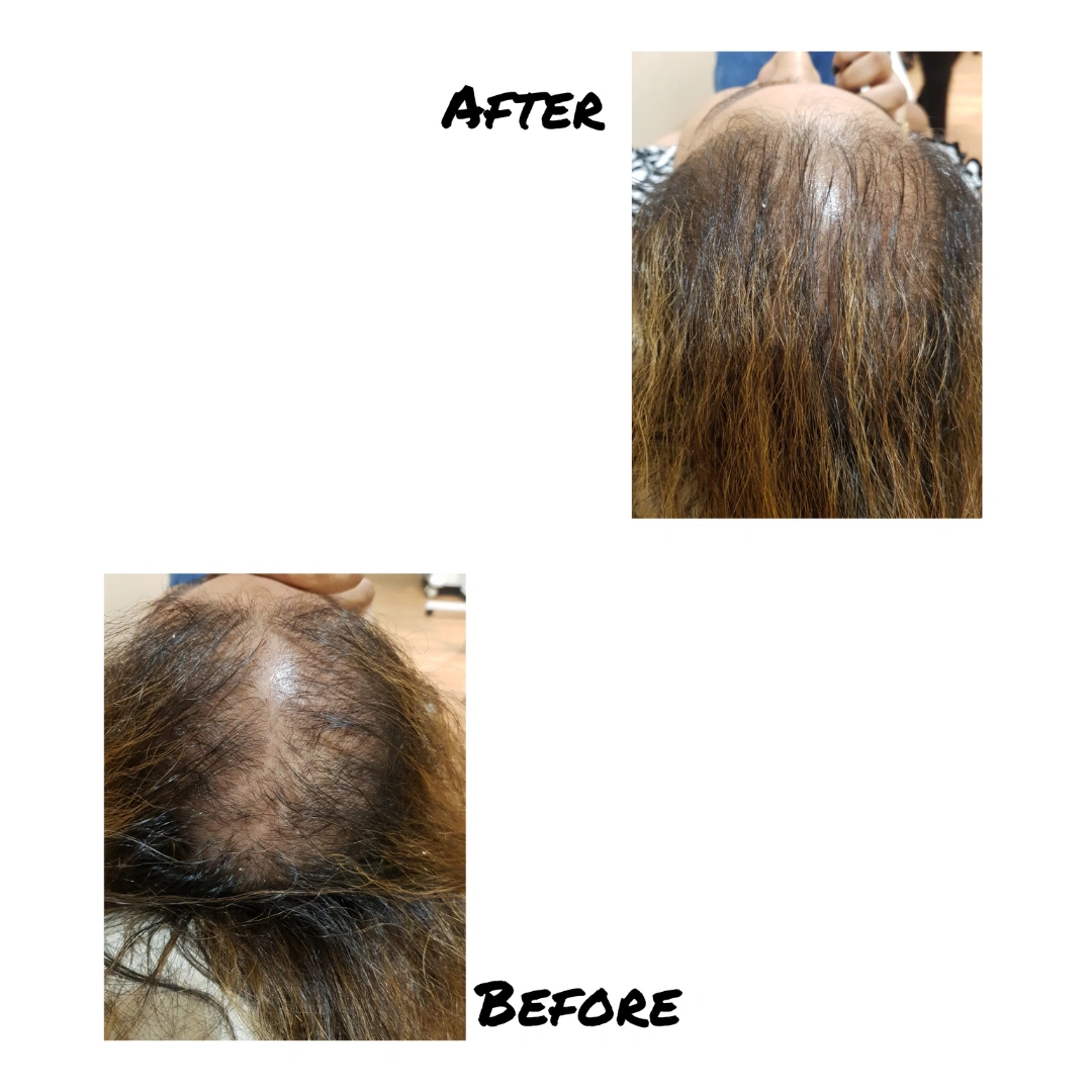 Hair Transplant Before & After Results 3
