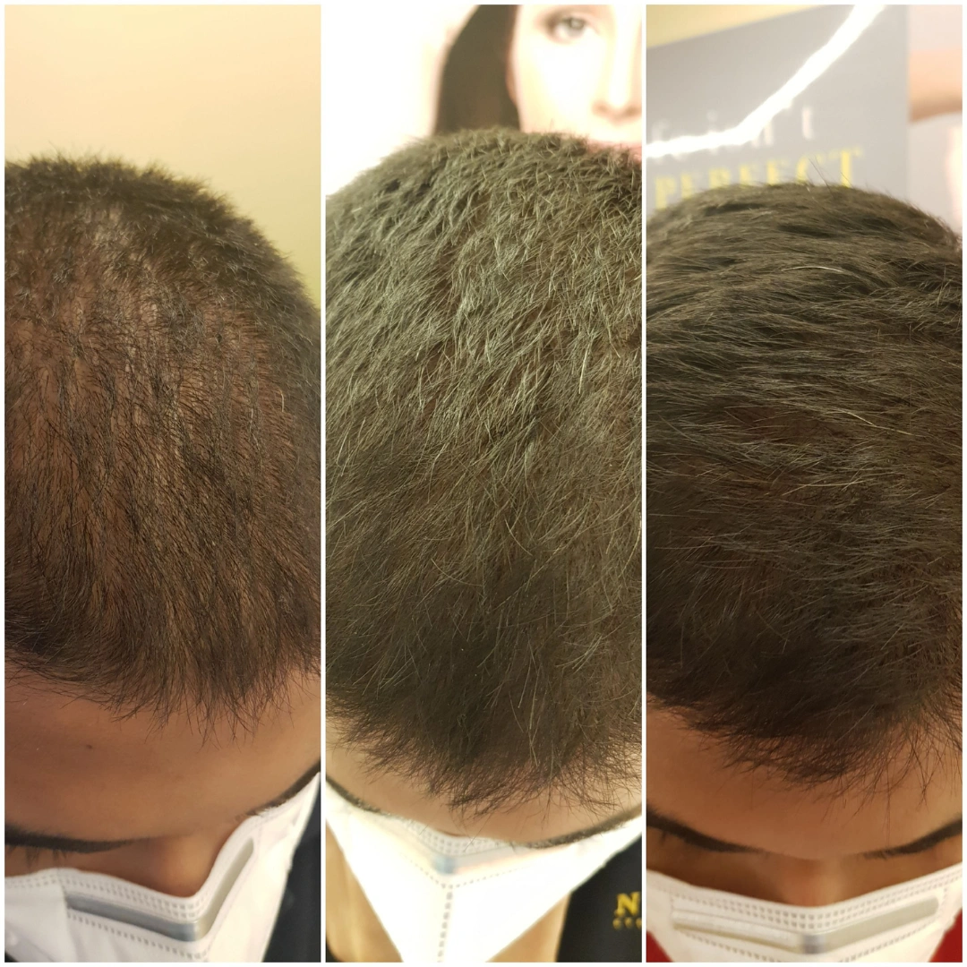 Hair Transplant Before & After Results 4