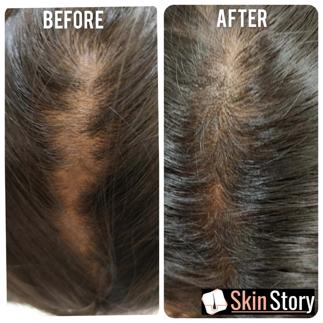 Hair Transplant Before & After Results 5