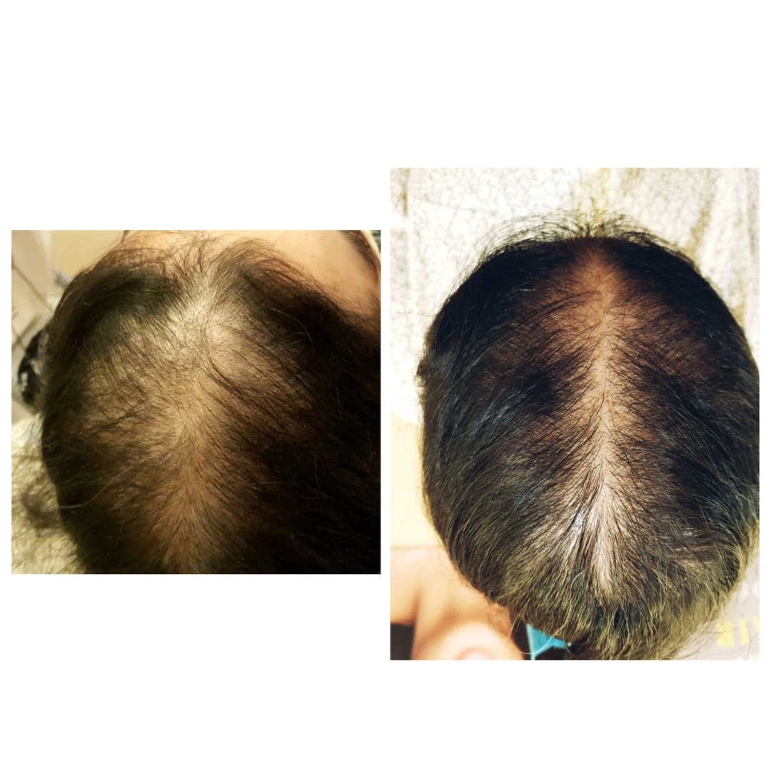 Hair Transplant Before & After Results 6