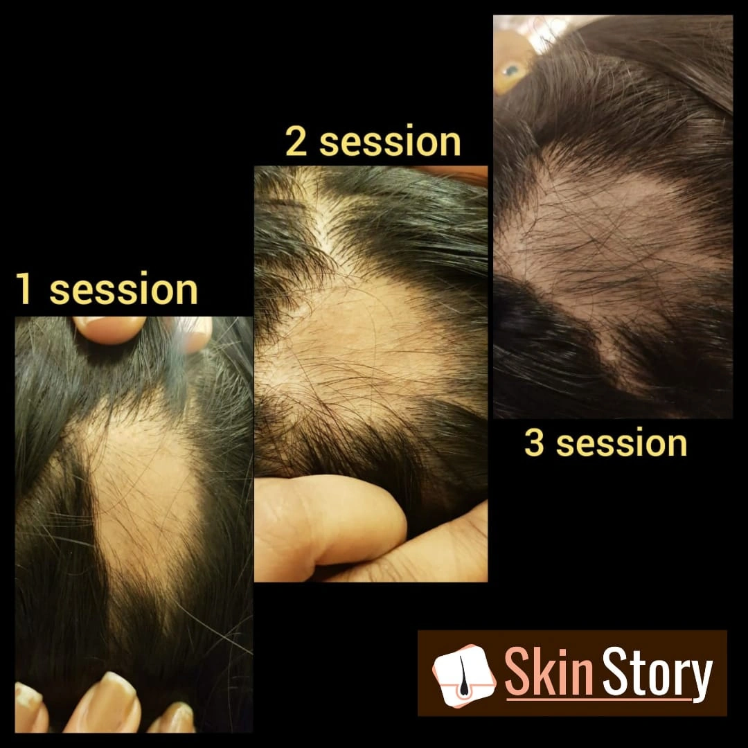 Hair Transplant Before & After Results 7