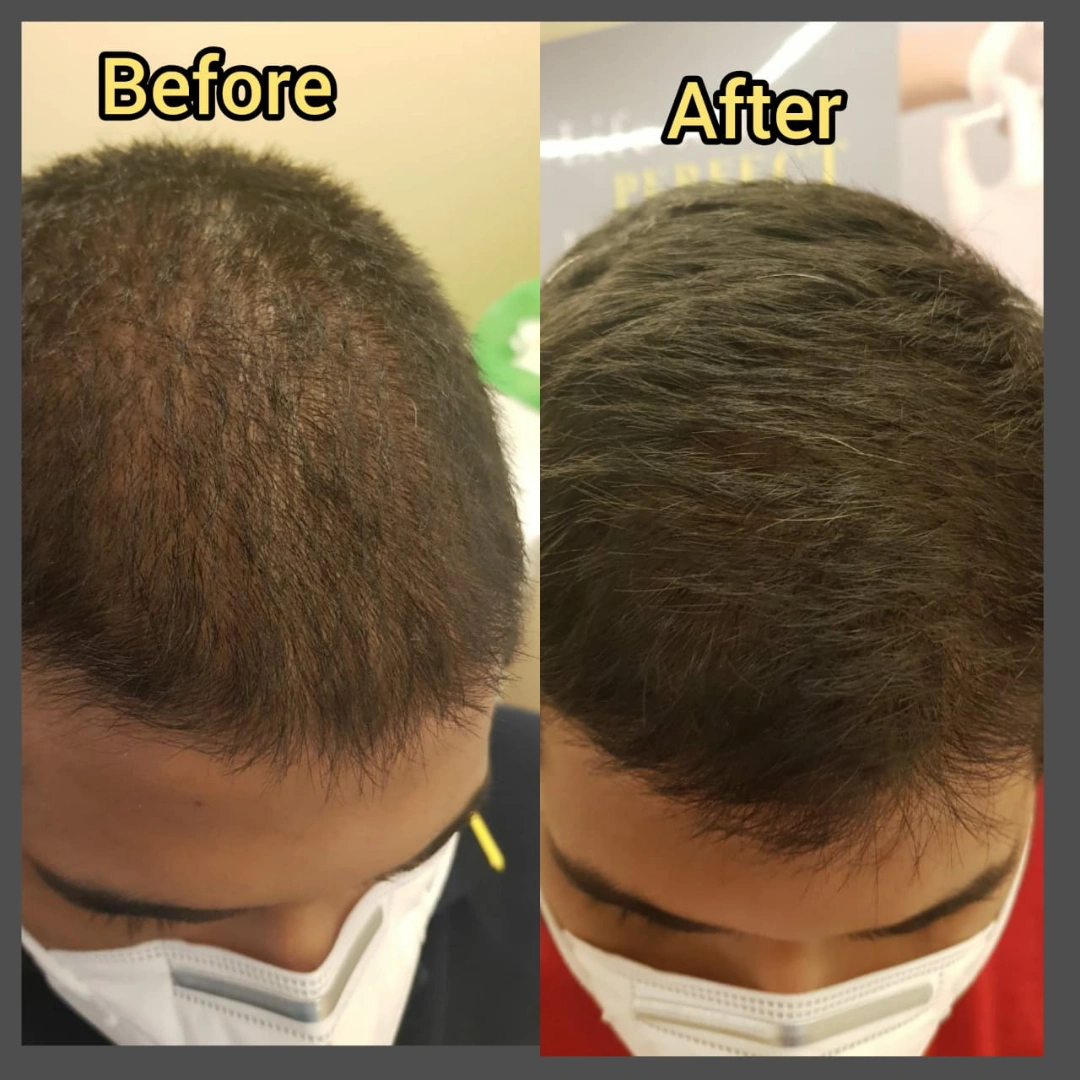 Hair Transplant Before & After Results 8