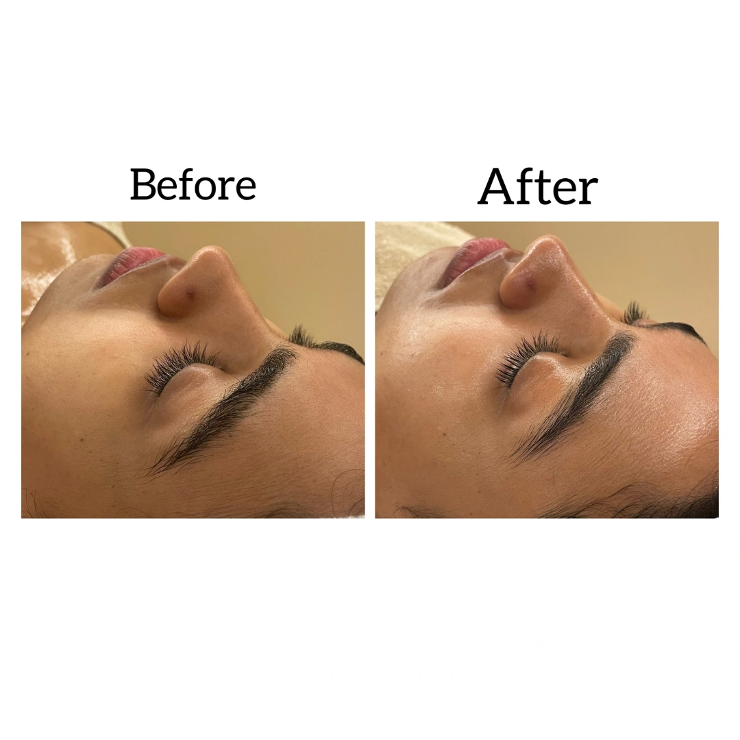 HydraFacial Treatments Before & After Results 1