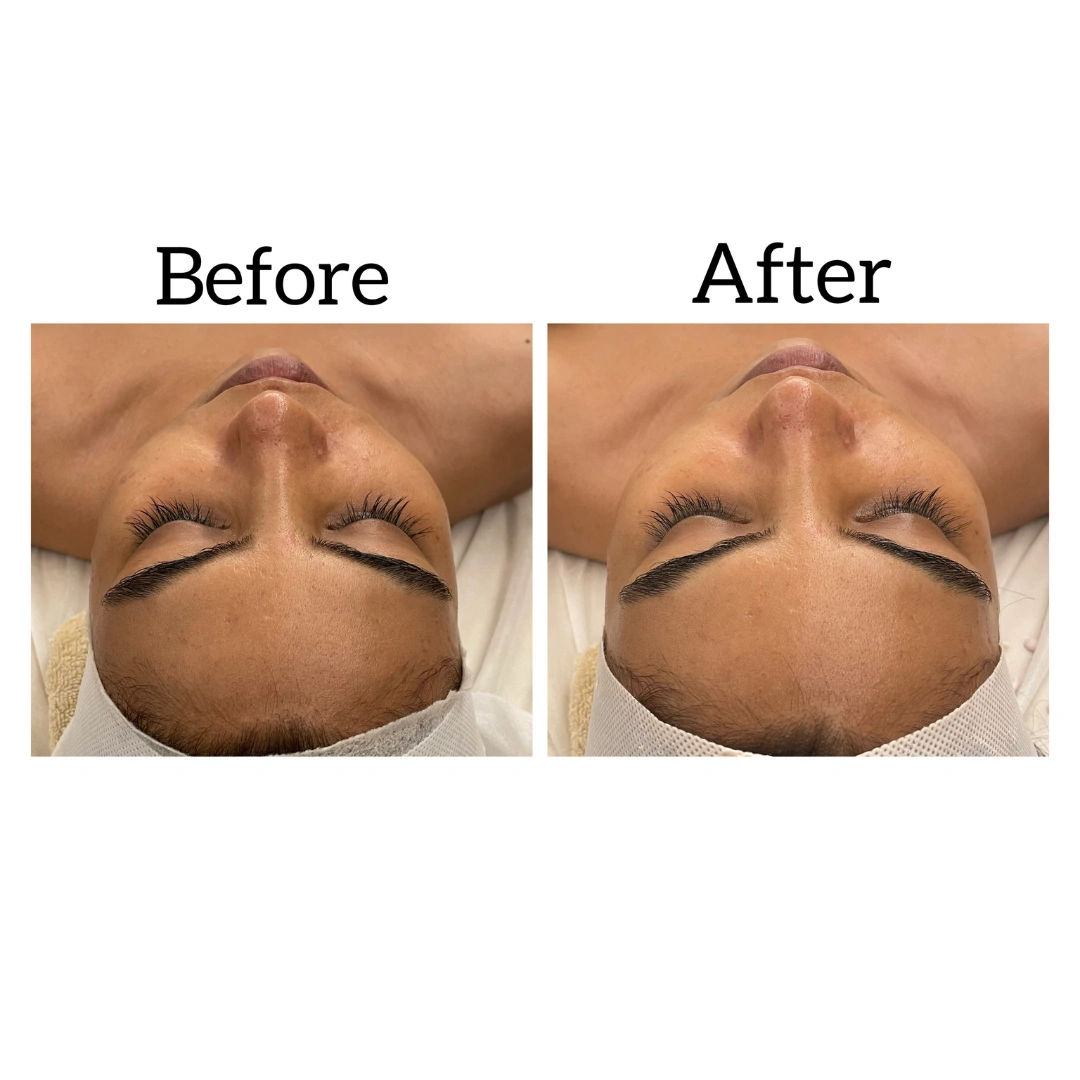 HydraFacial Treatments Before & After Results 2