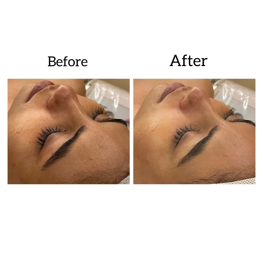 HydraFacial Treatments Before & After Results 3