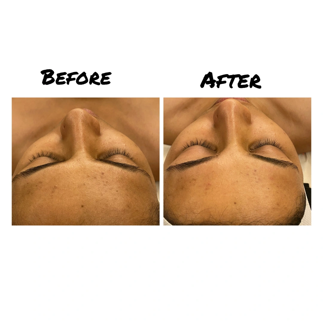 HydraFacial Treatments Before & After Results 4
