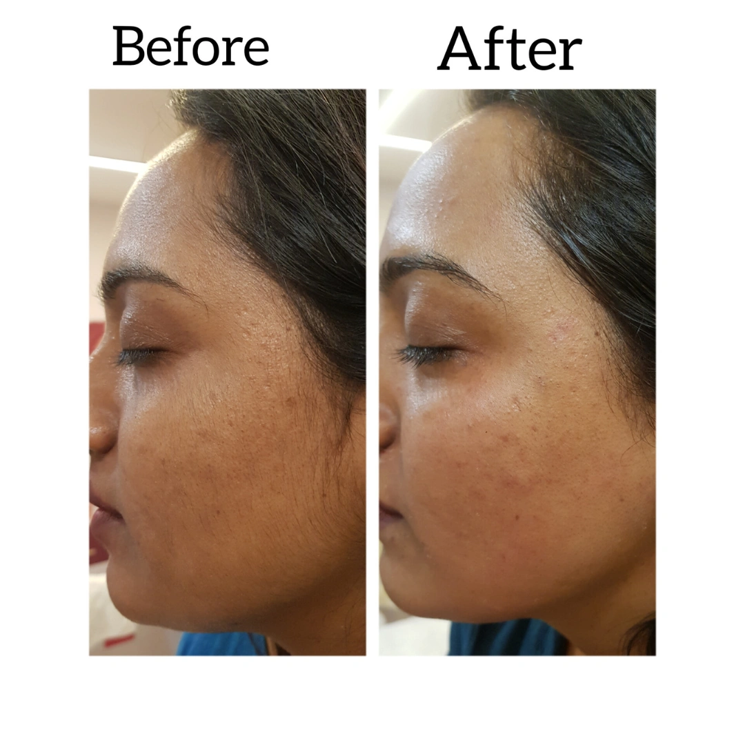 HydraFacial Treatments Before & After Results 5