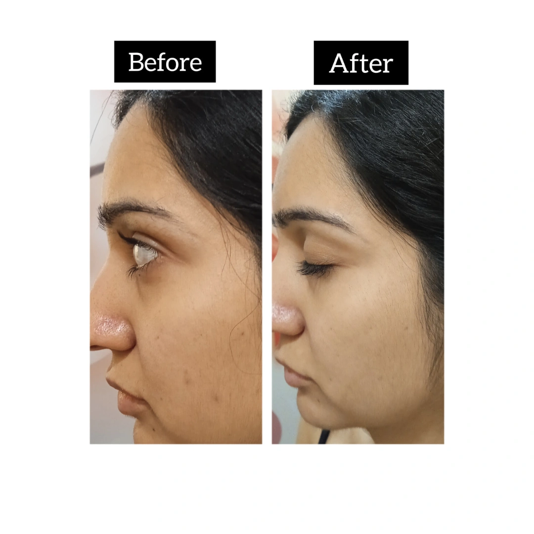 HydraFacial Treatments Before & After Results 6