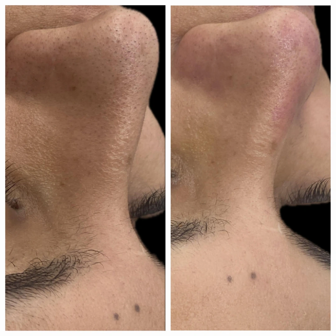 HydraFacial Treatments Before & After Results 7