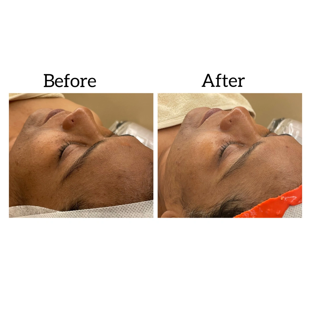 HydraFacial Treatments Before & After Results 8
