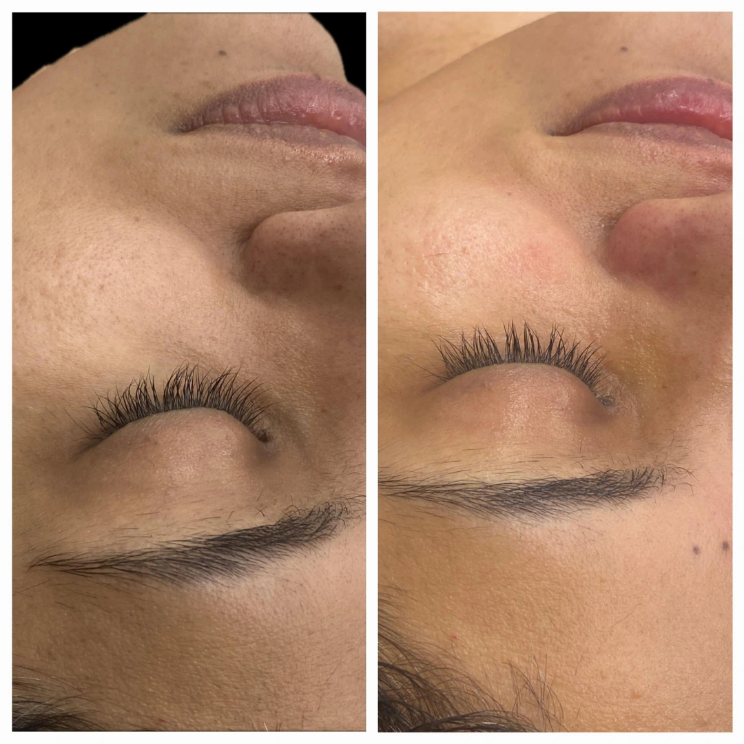 HydraFacial Treatments Before & After Results 9