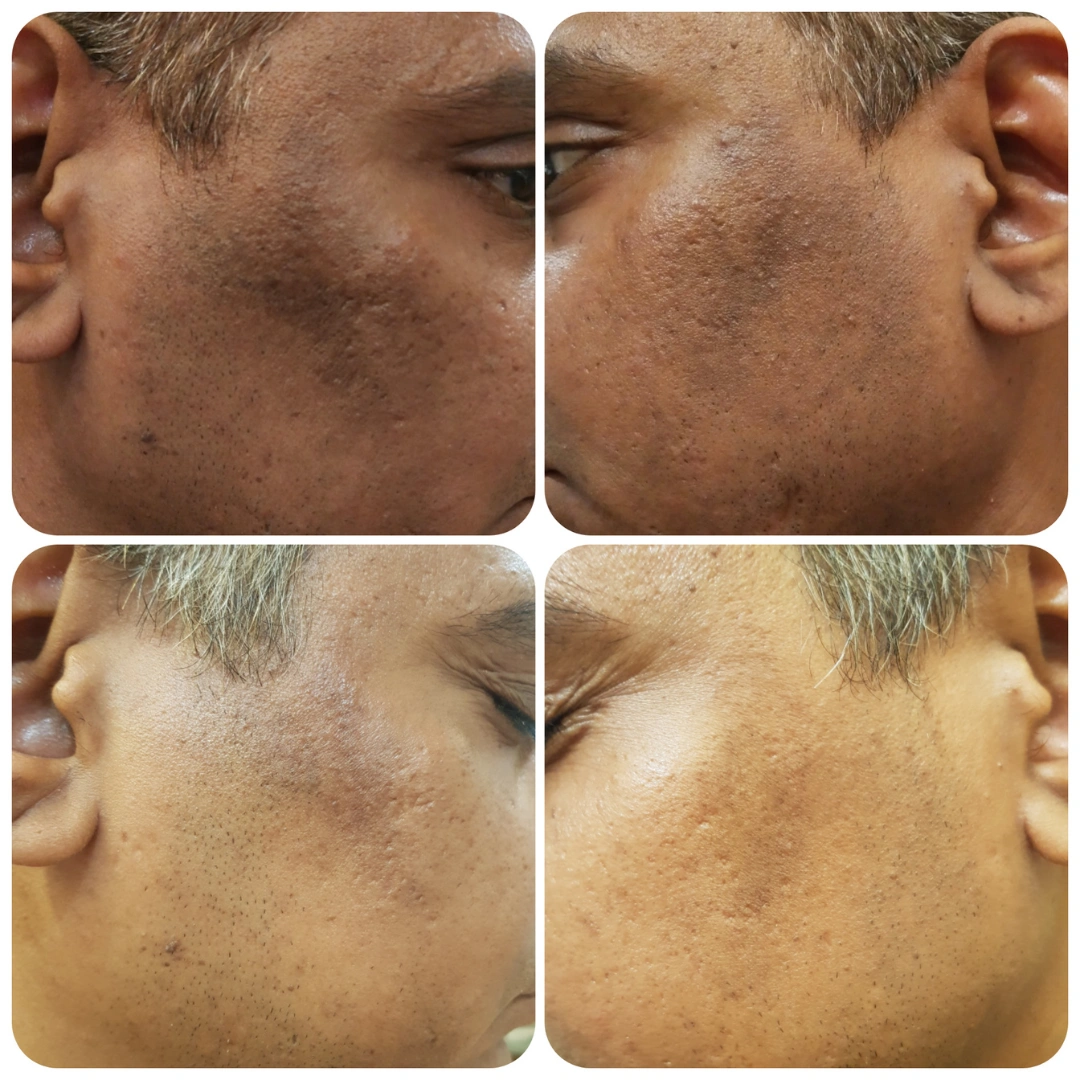 Skin Pigmentation Treatment Before & After Results 1