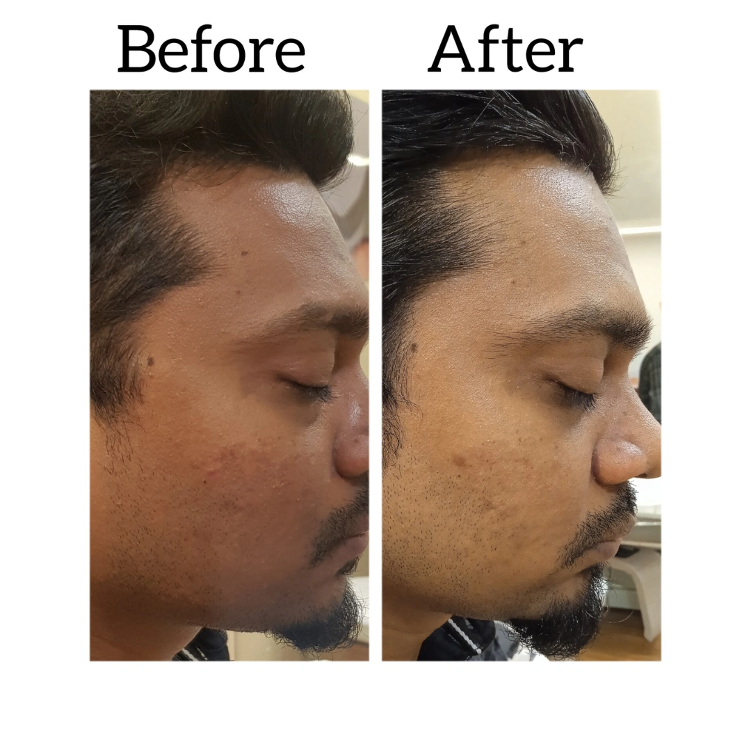 Skin Pigmentation Treatment Before & After Results 10