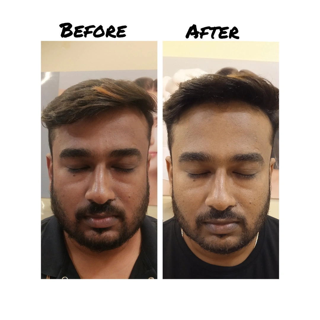 Skin Pigmentation Treatment Before & After Results 11