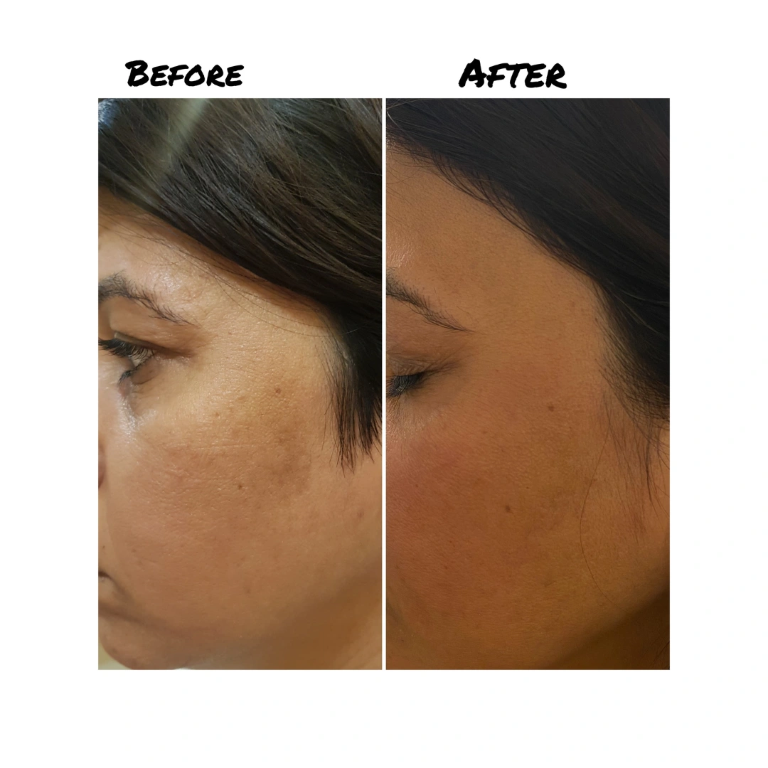 Skin Pigmentation Treatment Before & After Results 12