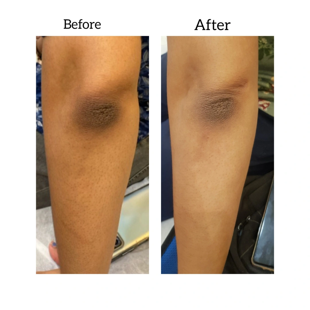 Skin Pigmentation Treatment Before & After Results 3