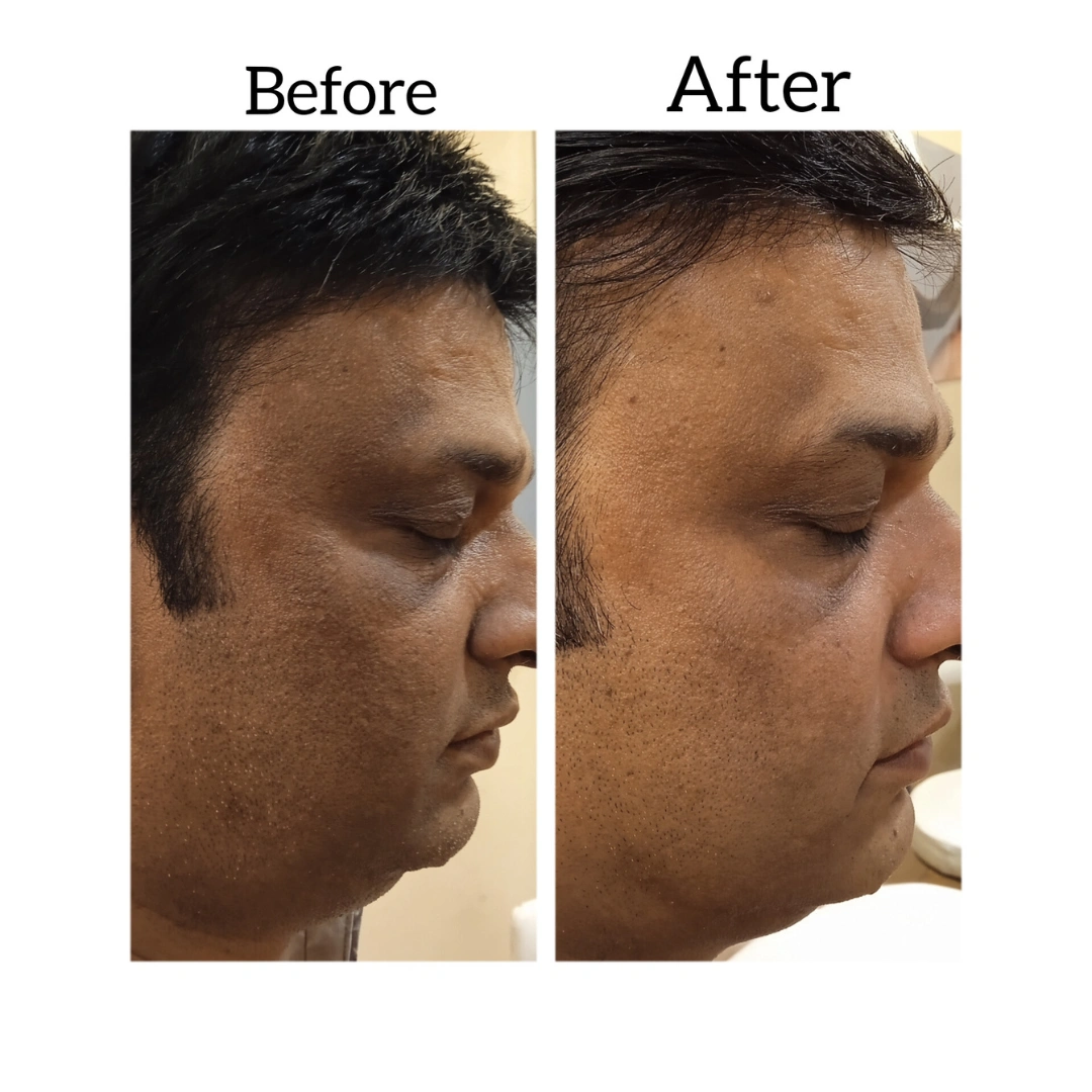 Skin Pigmentation Treatment Before & After Results 4