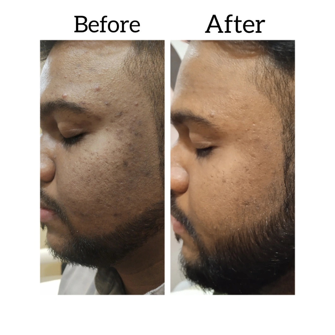 Skin Pigmentation Treatment Before & After Results 5