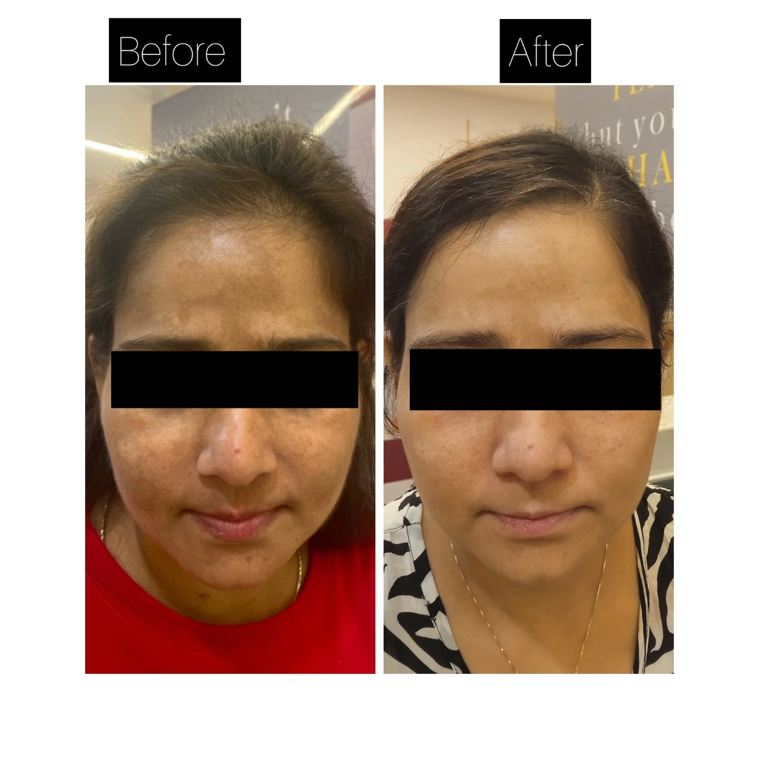 Skin Pigmentation Treatment Before & After Results 7