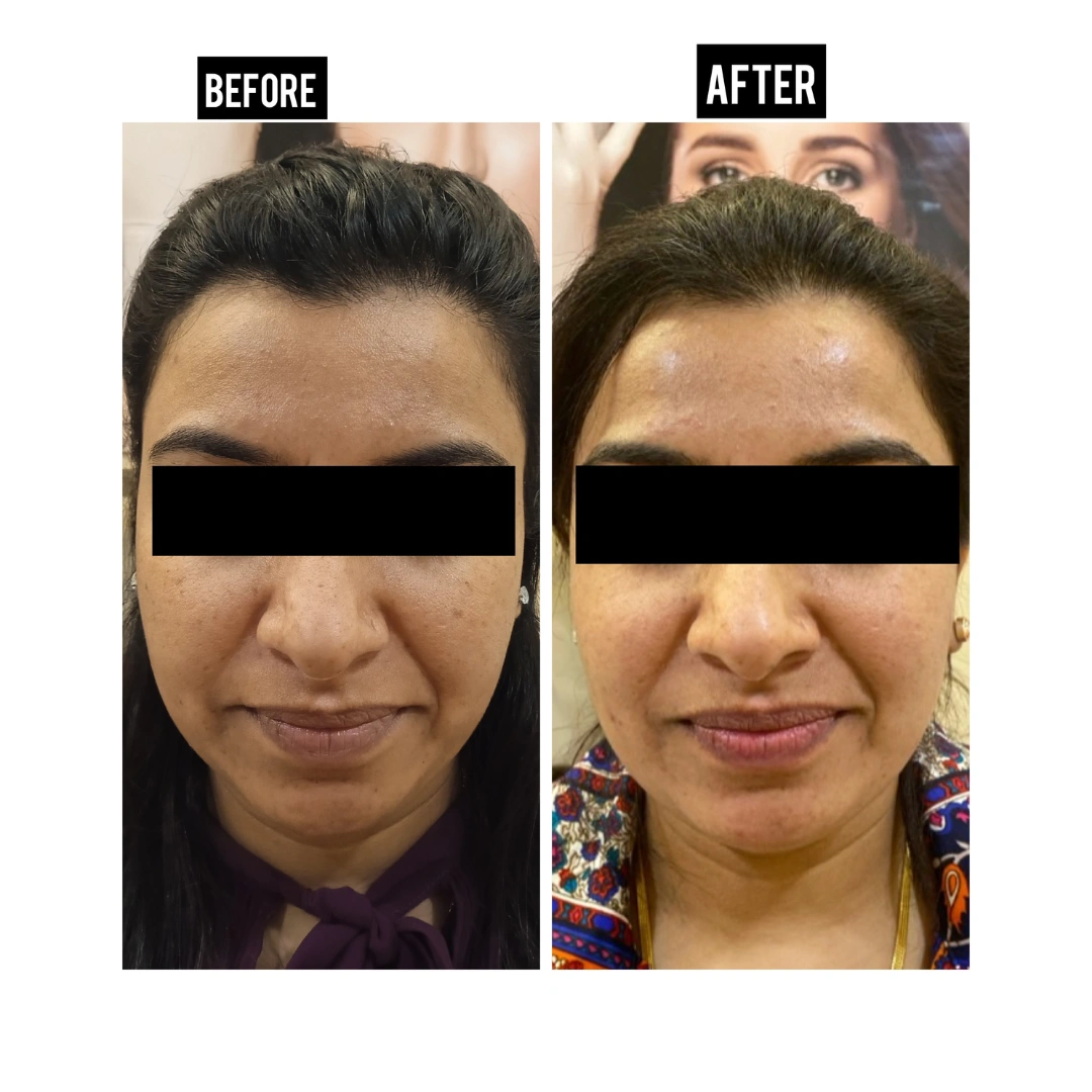 Skin Pigmentation Treatment Before & After Results 9