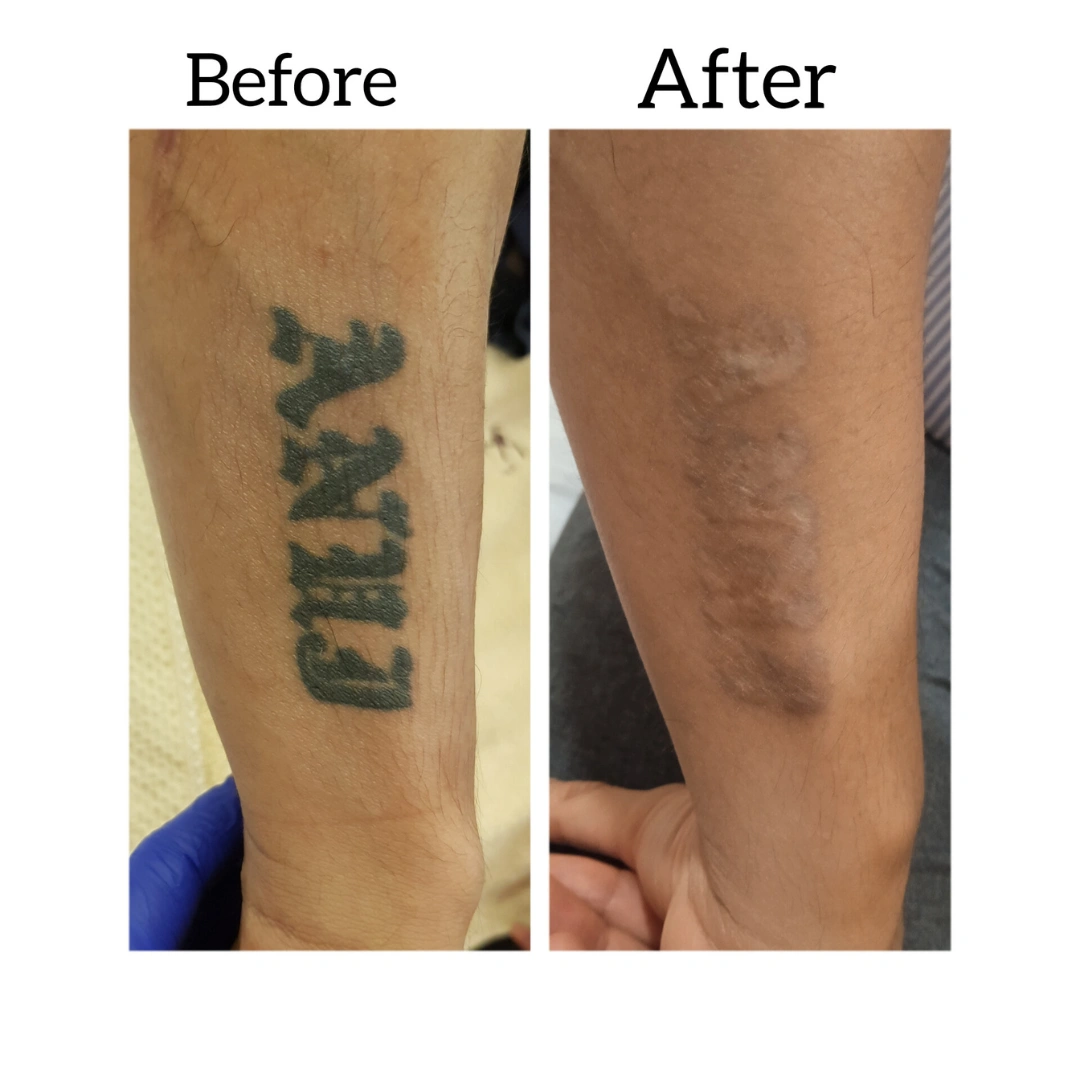 Tattoo Removal Treatment Before & After Results 1