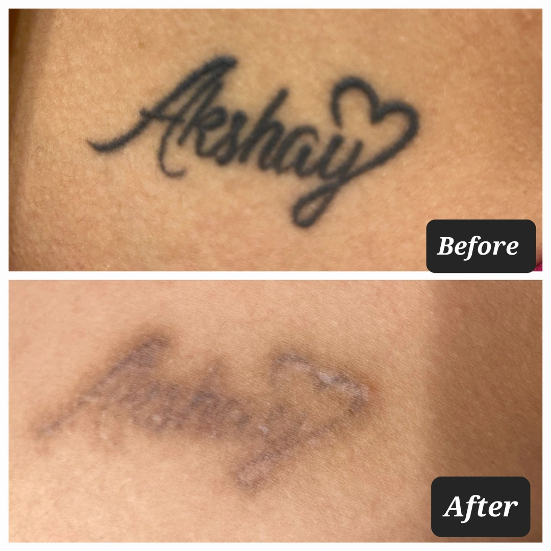 Tattoo Removal Treatment Before & After Results 2