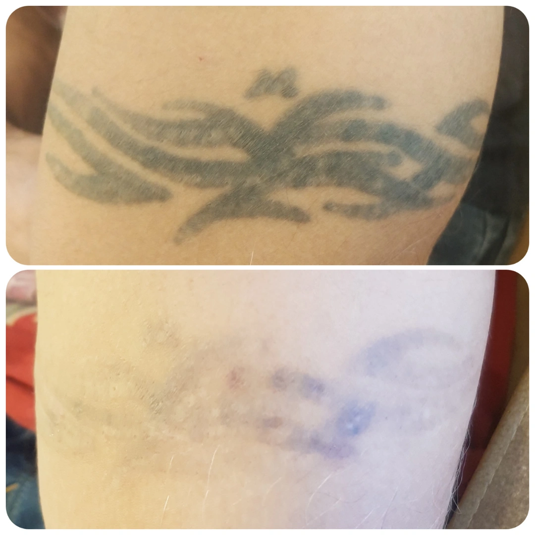 Tattoo Removal Treatment Before & After Results 3