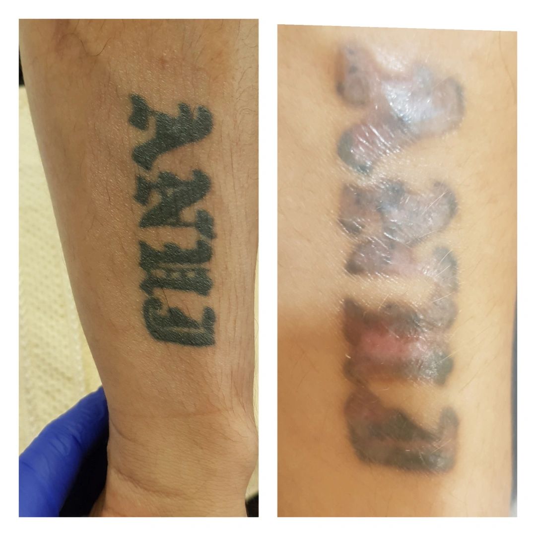 Tattoo Removal Treatment Before & After Results 6