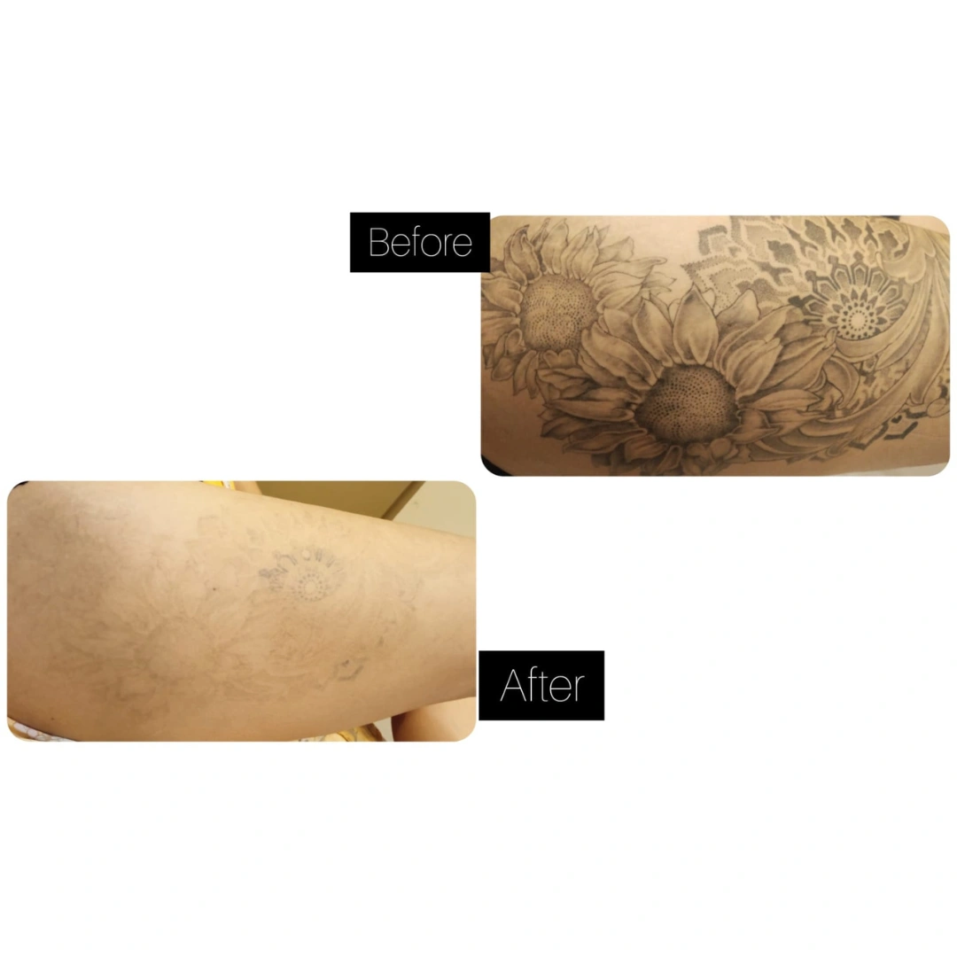 Tattoo Removal Treatment Before & After Results 8