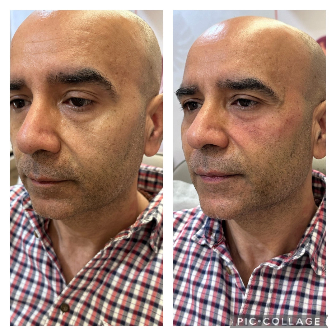 Dark Circles Treatment Before & After Results 1